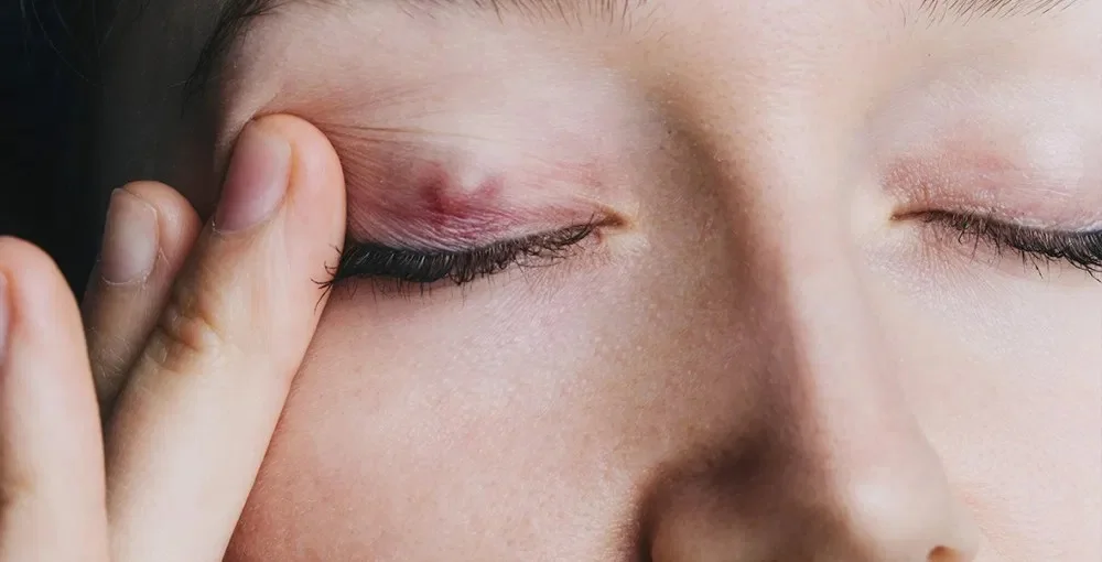 akių ligos katarakta mėlyna šviesa miesto optika akių klinika korekciniai akiniai lęšiai