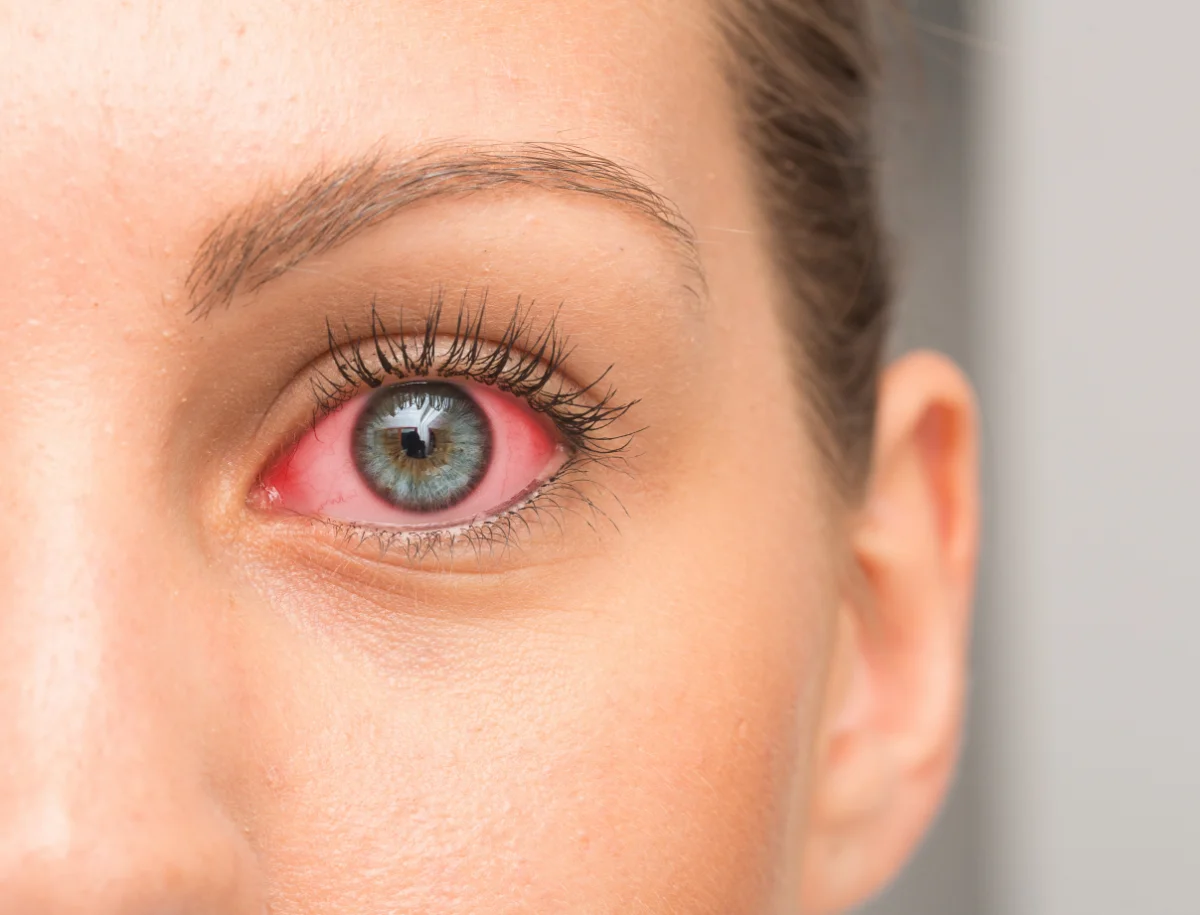 akių ligos katarakta mėlyna šviesa miesto optika akių klinika korekciniai akiniai lęšiai