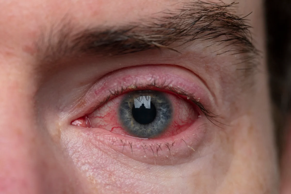 akių ligos katarakta mėlyna šviesa miesto optika akių klinika korekciniai akiniai lęšiai